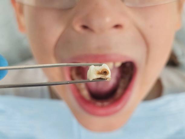 Best Emergency Root Canal Therapy in Maypearl, TX